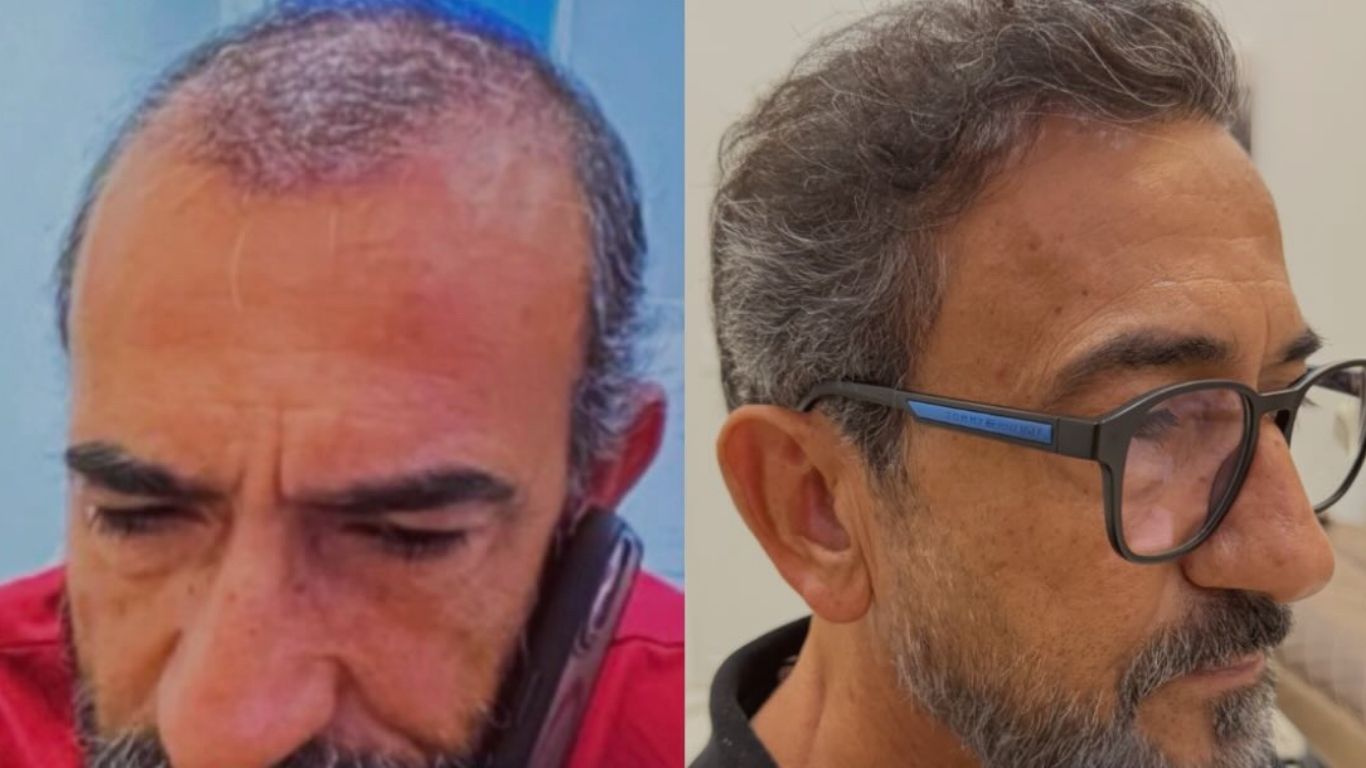 Antes e depois de um homem que realizou transplante capilar, mostrando a evolução do crescimento do cabelo.