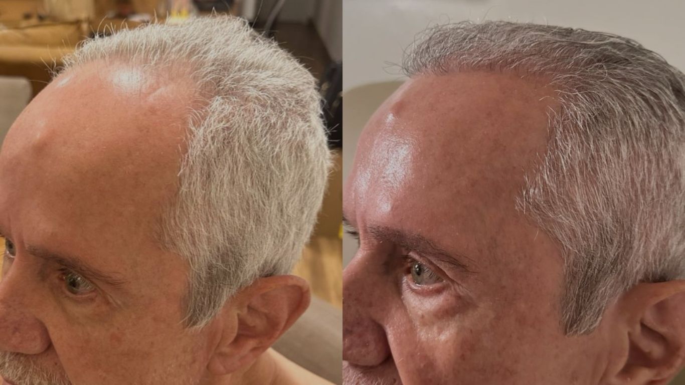 Comparação de antes e depois de um transplante capilar em homem de meia-idade com cabelo grisalho, mostrando o aumento da densidade capilar.