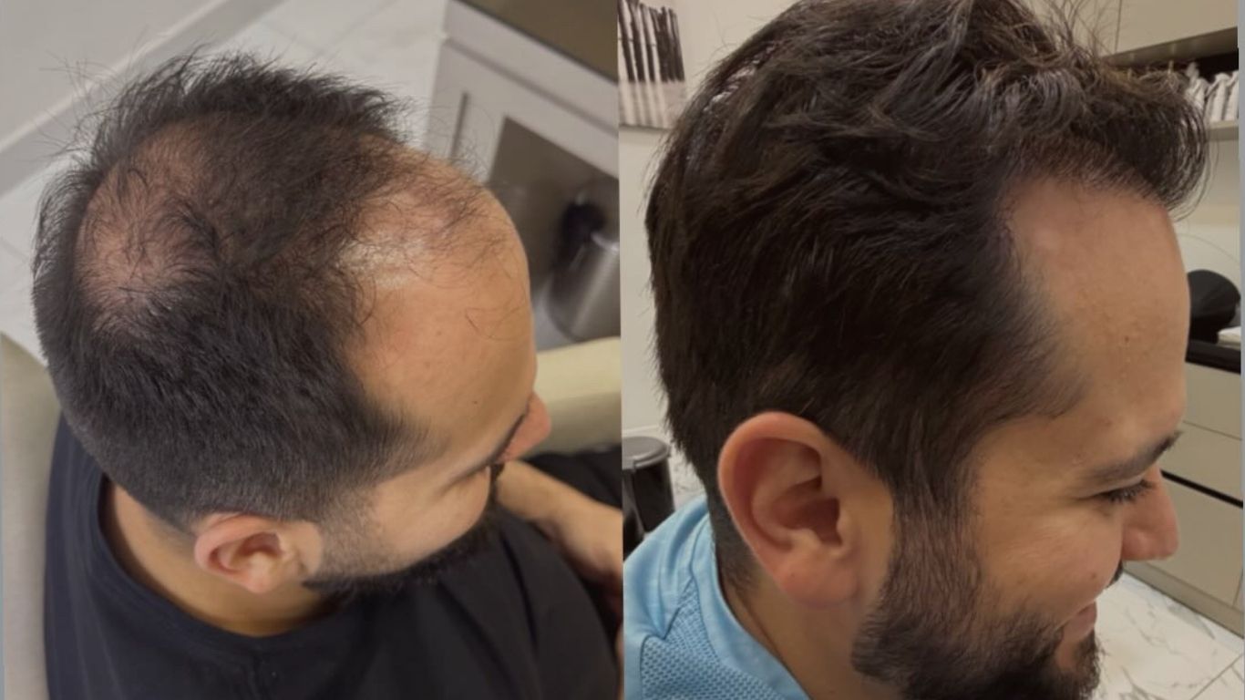 Comparação antes e depois do tratamento capilar, mostrando evolução do preenchimento da calvície na coroa.