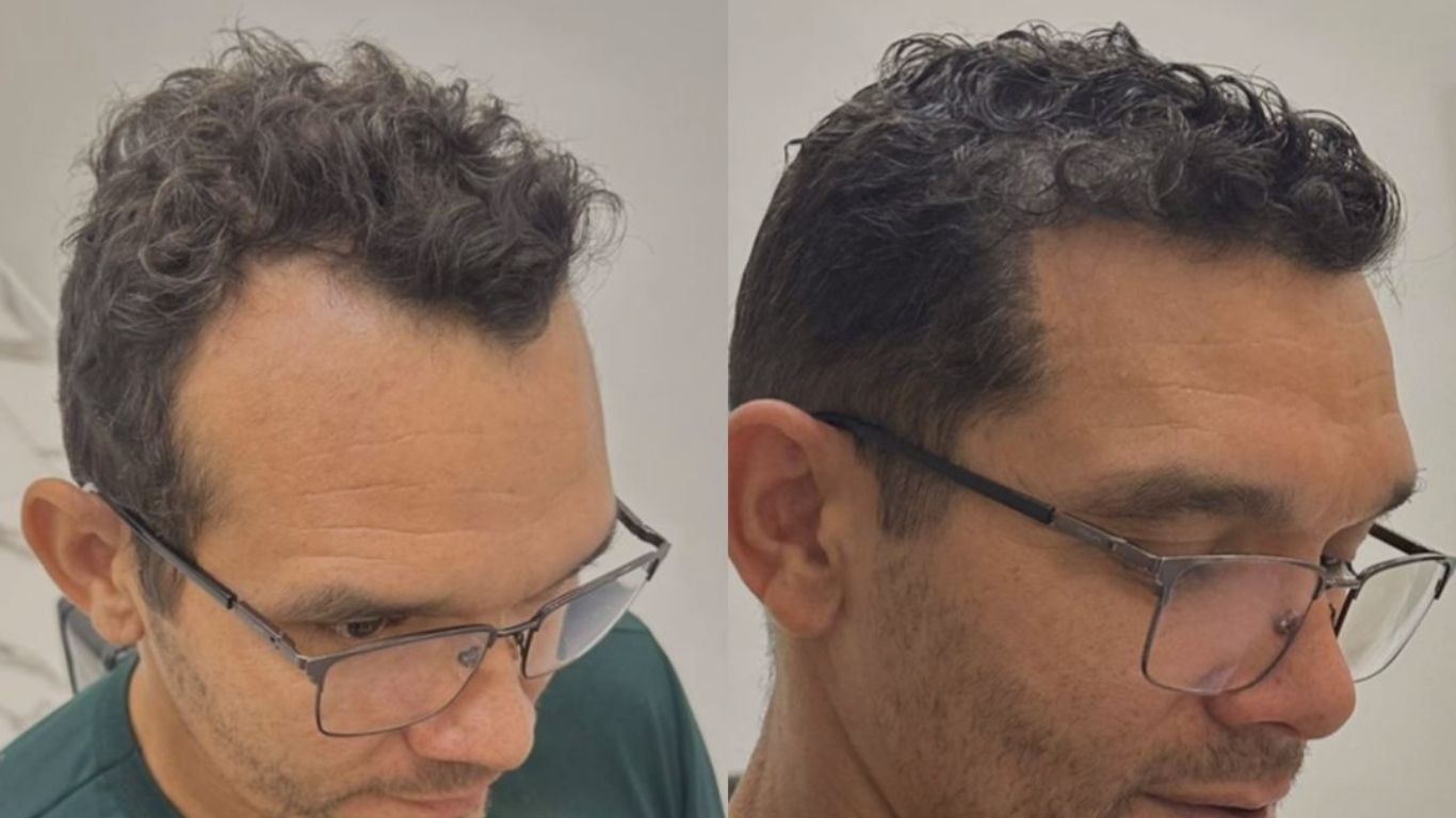 Comparação de transplante capilar masculino: antes (calvície frontal) e depois (cabelo denso e natural), ambos de perfil.