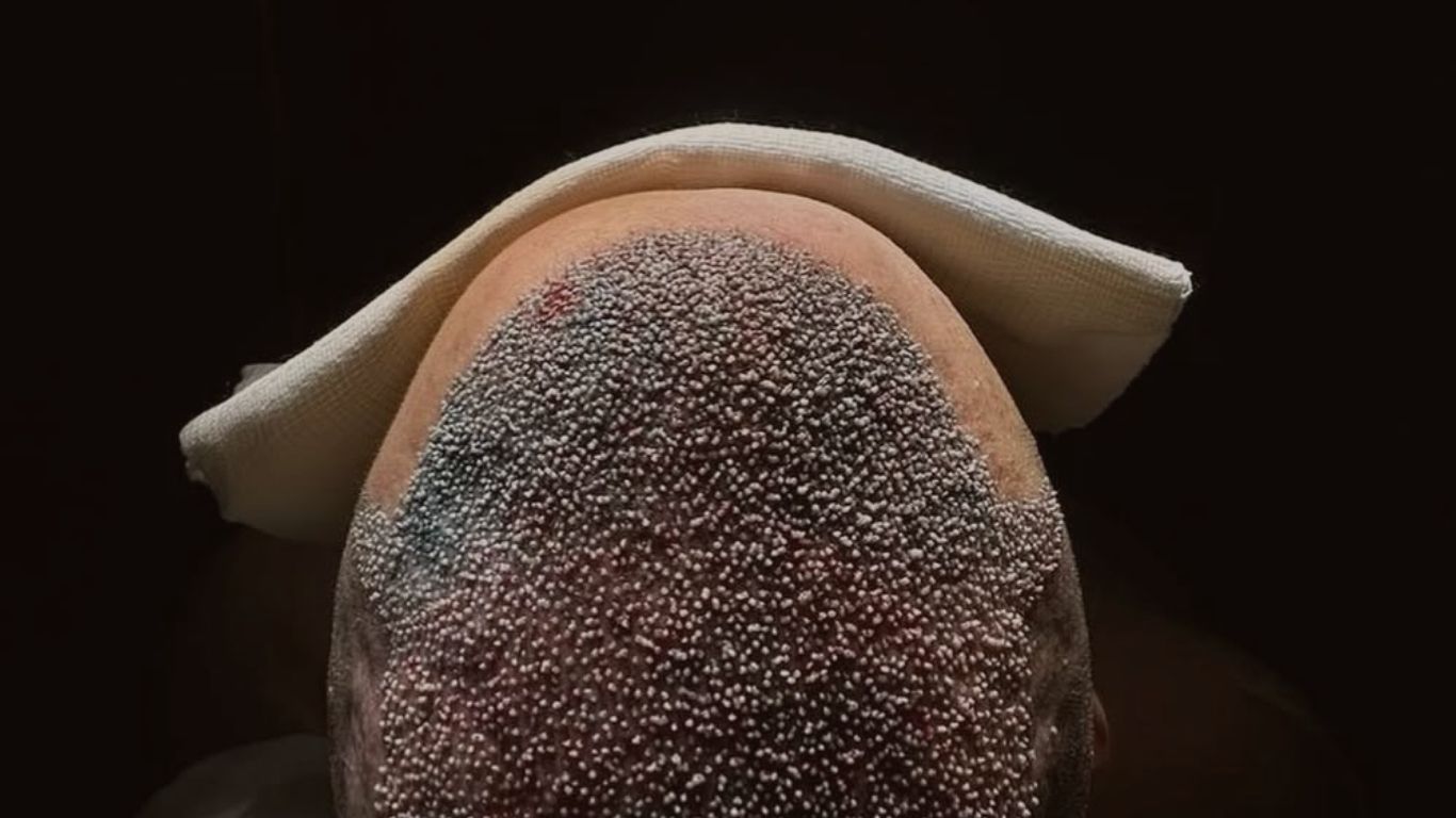 Close do topo de uma cabeça masculina evidenciando folículos recém-implantados em um procedimento de transplante capilar.